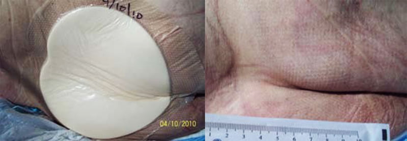 Băng trị loét vùng cùng cụt Mepilex Border Sacrum Băng trị loét vùng cùng cụt Mepilex Border Sacrum dẫn chứng thực tế