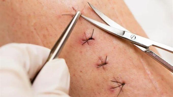 Các loại chỉ phẫu thuật phổ biến chỉ phẫu thuật có loại tự tiêu và không tiêu