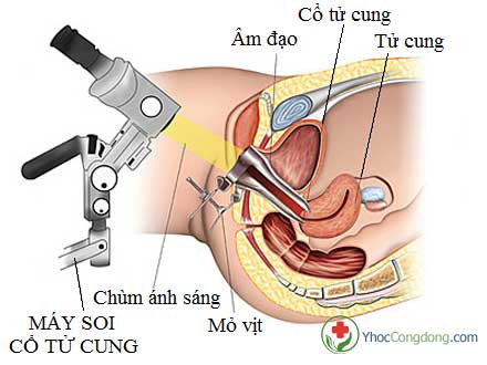 Đèn khử khuẩn 59S SunClean™ Bulb Light (A60/A19) soi cổ tử cung là gì