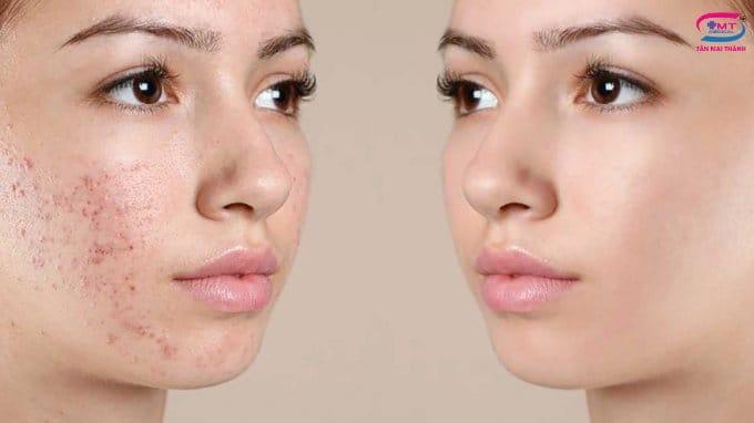 Acid hypochlorous giải pháp chăm sóc da hiệu quả và an toàn