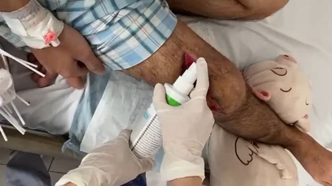 Điều trị vết thương có tiết dịch nặng hoặc chảy mủ bằng dung dịch rửa vết thương Granudacyn