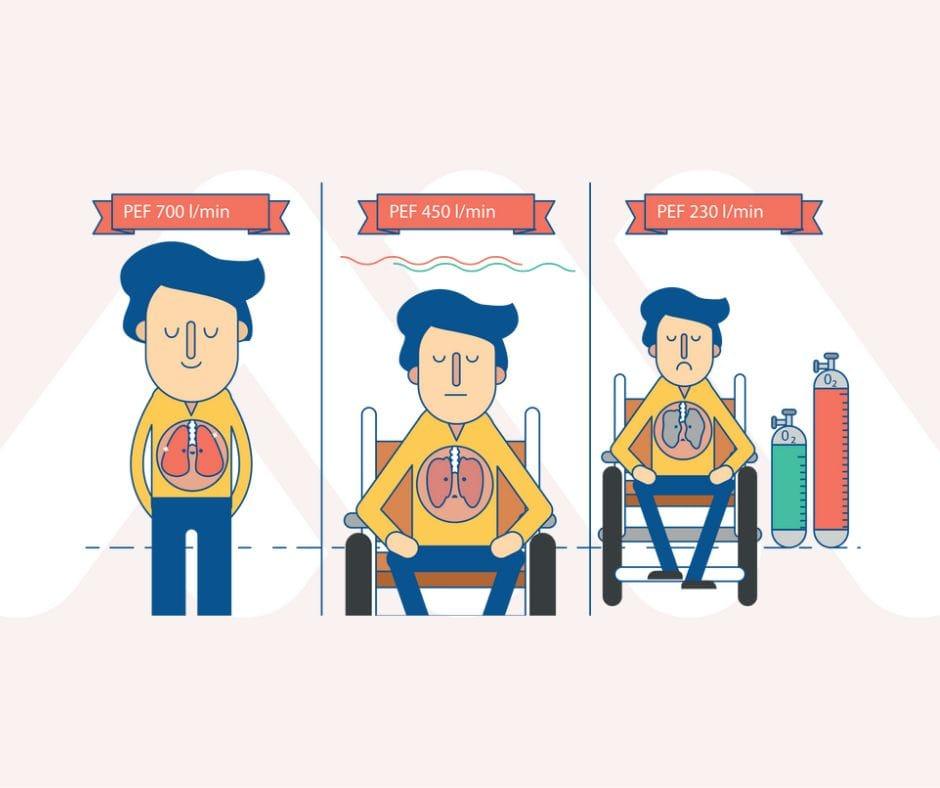 Không chỉ hen suyễn và COPD: các bệnh thần kinh cơ và phổi
