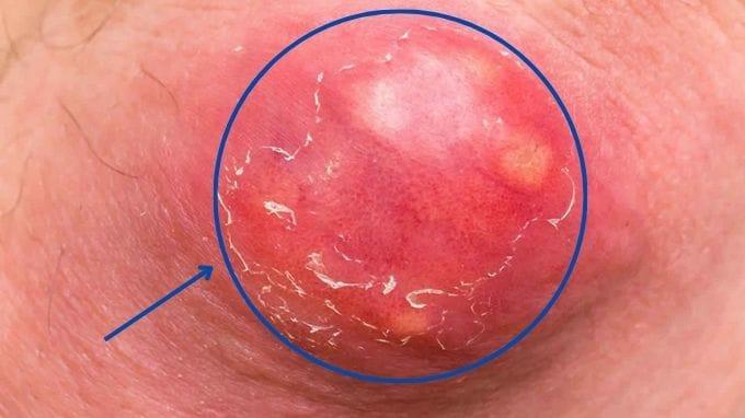 vết thương có tiết dịch, chảy mủ