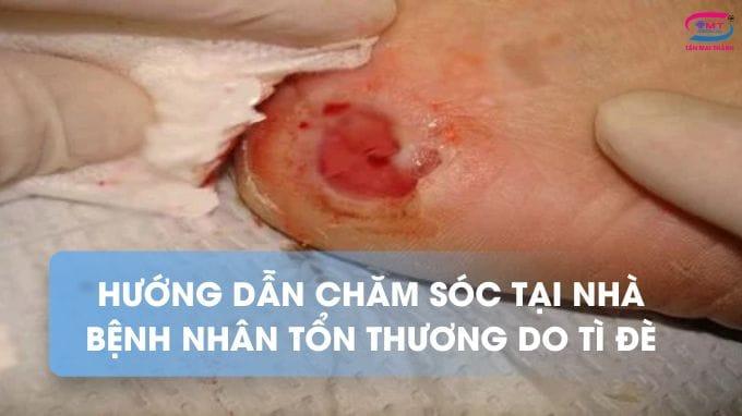 Hướng dẫn chăm sóc tại nhà bệnh nhân tổn thương tì đè