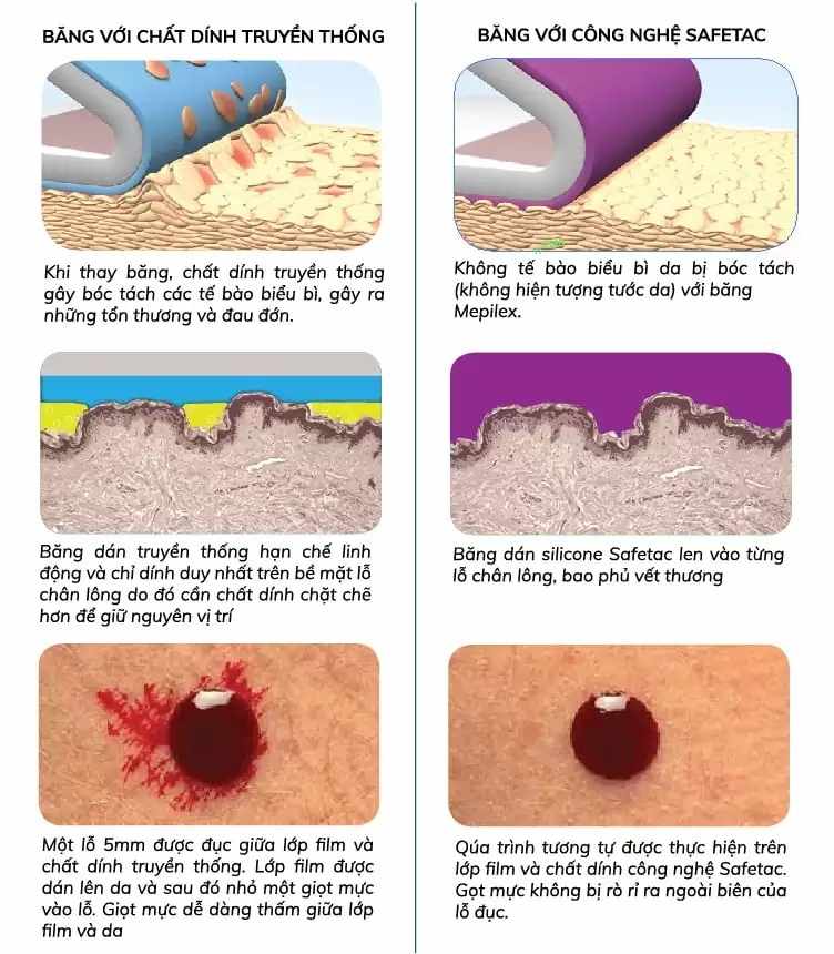 Mepilex Ag được các chuyên gia tin tưởng trong điều trị bỏng