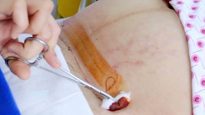 Nhiễm trùng vết mổ: định nghĩa, phân loại, biểu hiện và cách để chăm sóc, phòng ngừa Phải làm gì khi vết mổ đã bị nhiễm trùng?