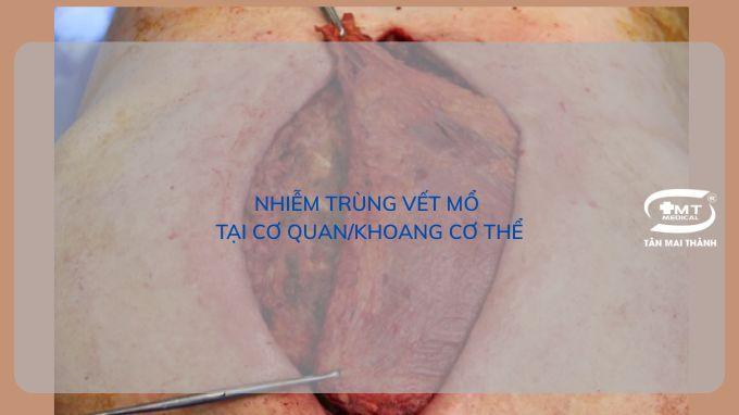 Nhiễm trùng vết mổ: định nghĩa, phân loại, biểu hiện và cách để chăm sóc, phòng ngừa Nhiễm trùng vết mổ tại cơ quan/khoang cơ thể