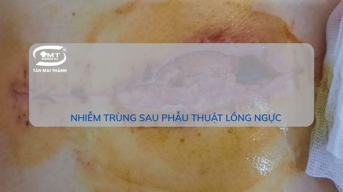 Nhiễm trùng vết mổ: định nghĩa, phân loại, biểu hiện và cách để chăm sóc, phòng ngừa nhiễm trùng vết mổ là gì