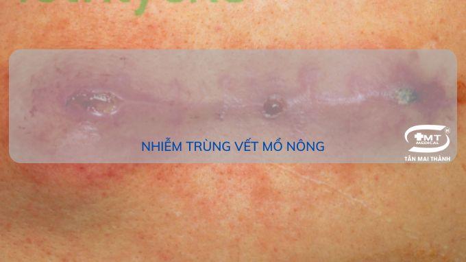 Nhiễm trùng vết mổ: định nghĩa, phân loại, biểu hiện và cách để chăm sóc, phòng ngừa Nhiễm trùng vết mổ nông