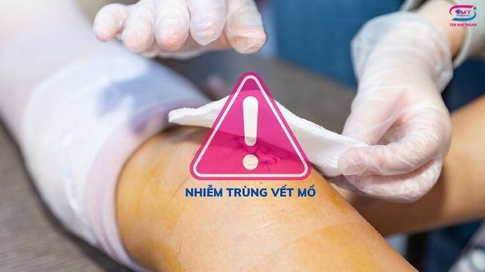 Nhiễm trùng vết mổ: định nghĩa, phân loại, biểu hiện và cách để chăm sóc, phòng ngừa