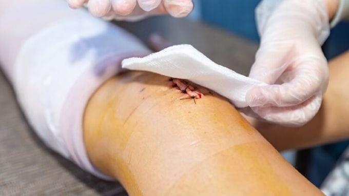 Nhiễm trùng vết mổ: định nghĩa, phân loại, biểu hiện và cách để chăm sóc, phòng ngừa Thay băng cho vết thương tránh nhiểm trùng vết mổ
