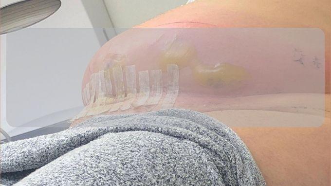 Nhiễm trùng vết mổ: định nghĩa, phân loại, biểu hiện và cách để chăm sóc, phòng ngừa Những lưu ý để tránh nhiễm trùng vết mổ