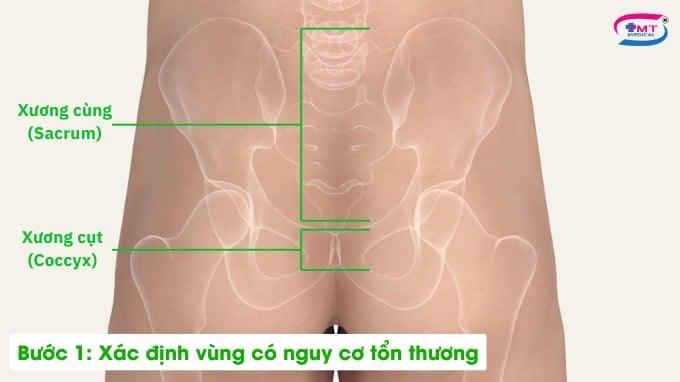 Hướng dẫn sử dụng băng dán vết thương Mepilex Border Sacrum Hướng dẫn sử dụng băng dán vết thương Mepilex Border Sacrum bước 1
