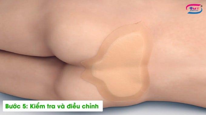 Hướng dẫn sử dụng băng dán vết thương Mepilex Border Sacrum Hướng dẫn sử dụng băng dán vết thương Mepilex Border Sacrum bước 5