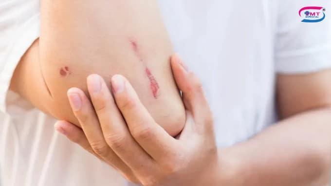 Vết thương lâu lành ở người tiểu đường: nguyên nhân và hướng xử lý Khi nào cần đến cơ sở y tế xử lí vết thương lâu lành