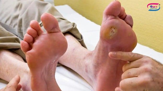 Vết thương lâu lành ở người tiểu đường: nguyên nhân và hướng xử lý Nguyên nhân khiến vết thương lâu lành