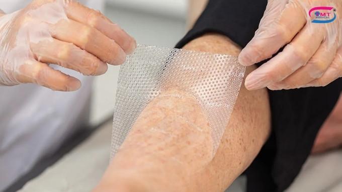 Sử dụng Mepitel One lên vết thương
