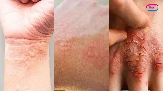 Găng tay latex và nitrile: Khác biệt về vật liệu và nguy cơ kích ứng da Viêm da do găng latex có phải lúc nào cũng là dị ứng latex?