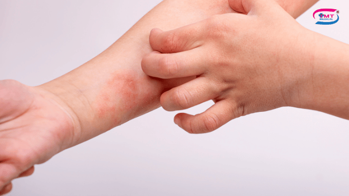 Găng tay y tế và mối liên hệ với viêm da cơ địa khi đeo trong thời gian dài Viêm da cơ địa khác gì viêm da tiếp xúc?