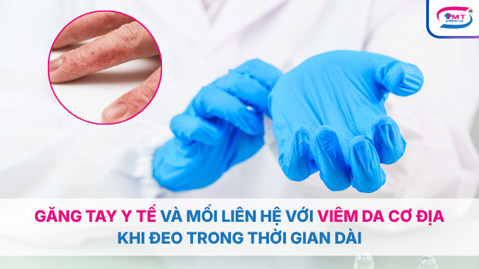 Găng tay y tế và mối liên hệ với viêm da cơ địa khi đeo trong thời gian dài